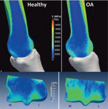 Healthy and Osteoarthritic Bone Density (Green = higher density bone). Mapped material stiffness on third metacarpal from micro-computed tomography images. Bottom images show the internal stiffness distribution through the medial/lateral plane of the distal end of MC3.