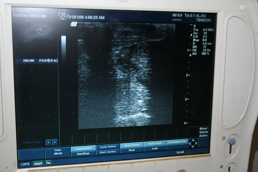 This ultrasound shows a core tendon lesion.